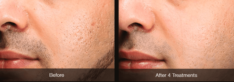 microneedling before and after